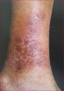 Dry skin on leg